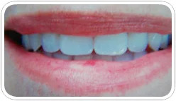 denture-1b