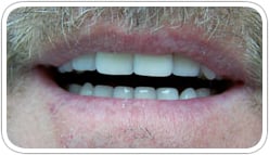 After Denture