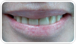 denture1a