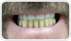 Before Denture