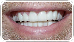 veneers_a_2