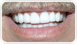 veneers_a_5