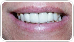 veneers_b_1