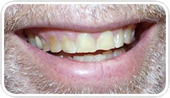 veneers_b_2