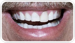 veneers_b_5
