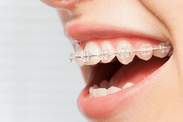 Straighten your teeth with the best invisible braces in Toms River, NJ. Call Dentistry With A Woman’s Touch at 732-736-0800.