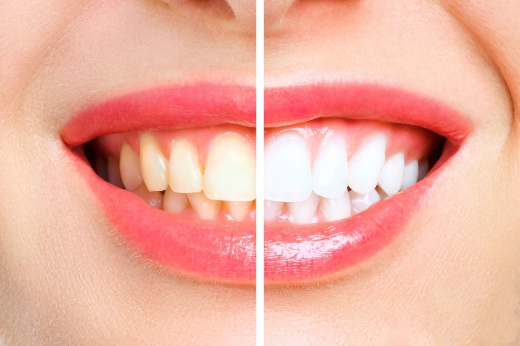 Side-by-side comparison of laser teeth whitening vs bleaching differences. Learn more at Dentistry With A Woman’s Touch in Toms River, NJ. Call 732-838-9525.