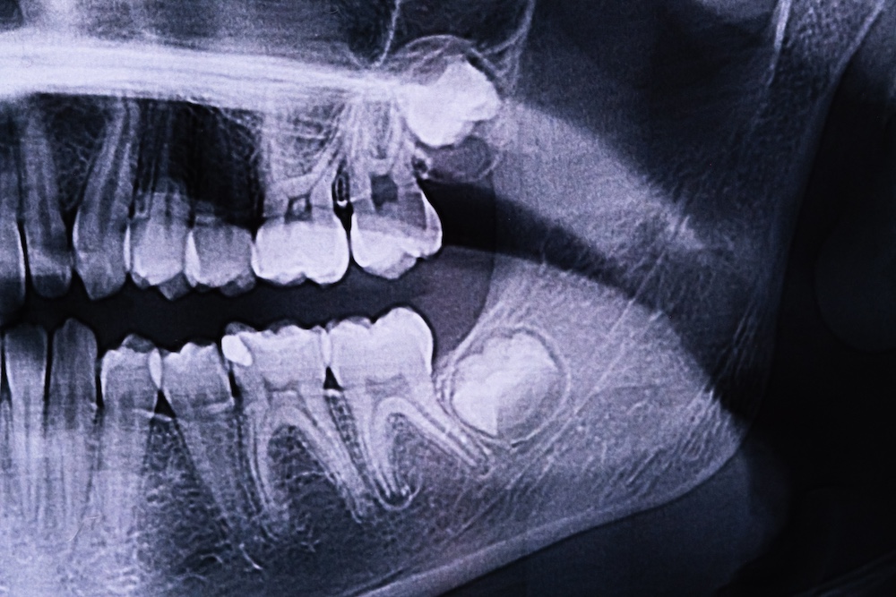 Toms River wisdom teeth extraction
