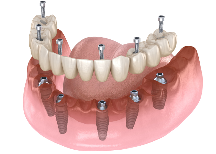 Fixed vs. Removable Implant Solutions