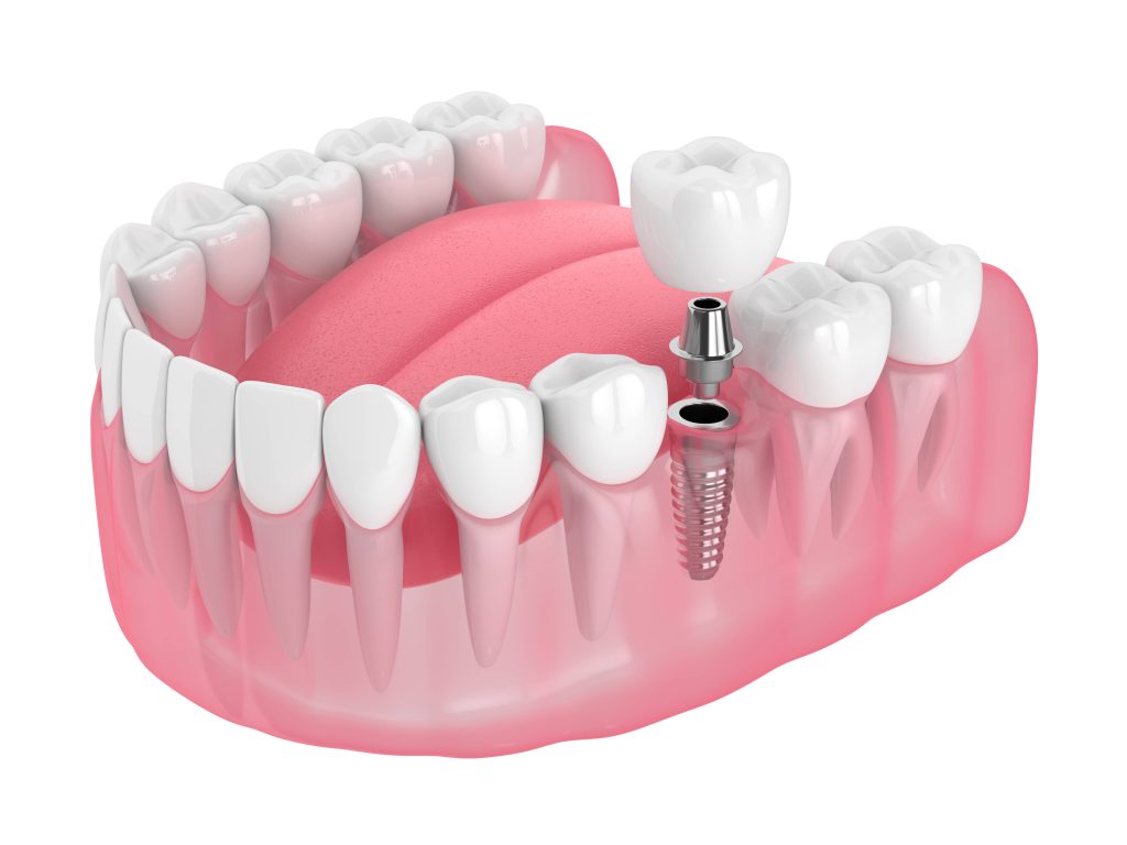 Single Missing Tooth Dental Implant