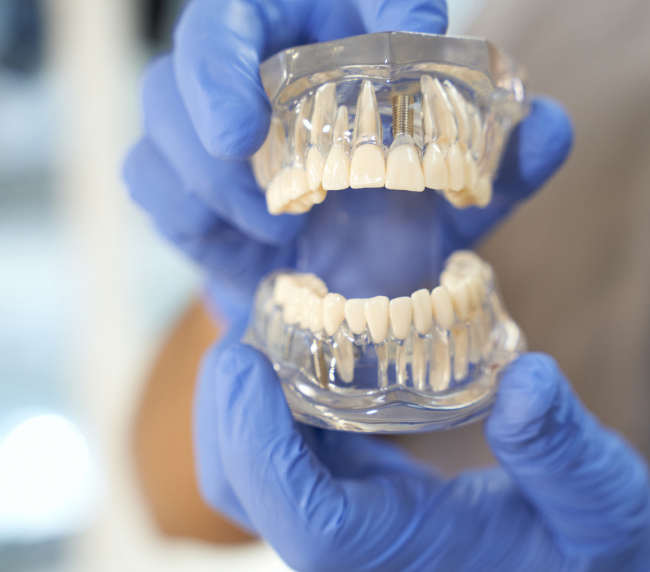 Benefits of Teeth-In-A-Day Implants