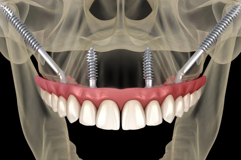 Zygomatic Implants
